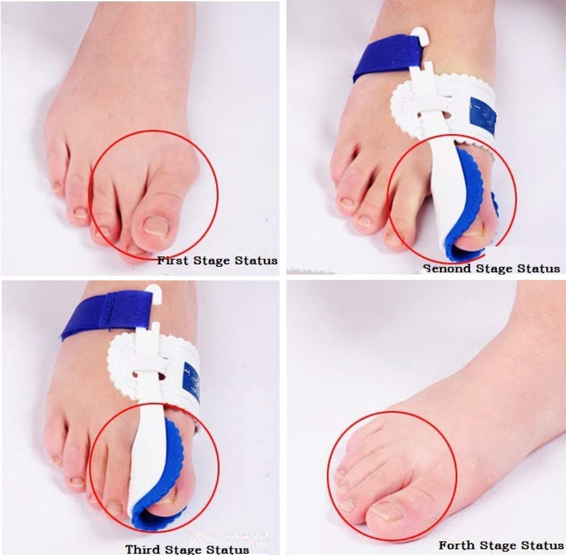 Pedimend, tutore per alluce valgo (giorno e notte), correttore per alluce valgo, raddrizzatore per alluce valgo, previene la progressione dell’alluce valgo, unisex