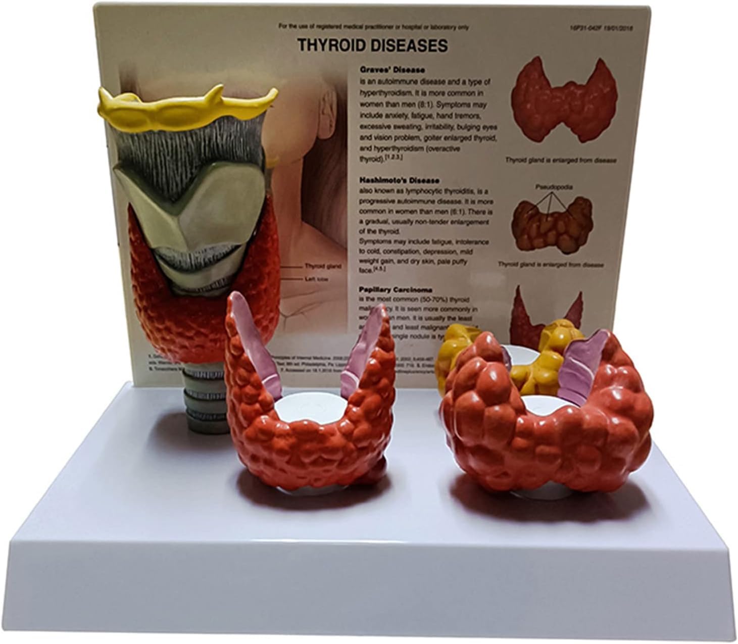 Modèle de thyroïde AMITD avec nodule pathologique pour l'étude de la santé
