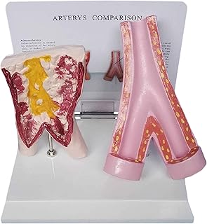 Study Model Anatomical Blood Model - Comparison Model Between Smoking Blood Vessels and Normal Blood Vessels Human Anatomy Organs Medical Model - for Medical Educational Training SaiFei
