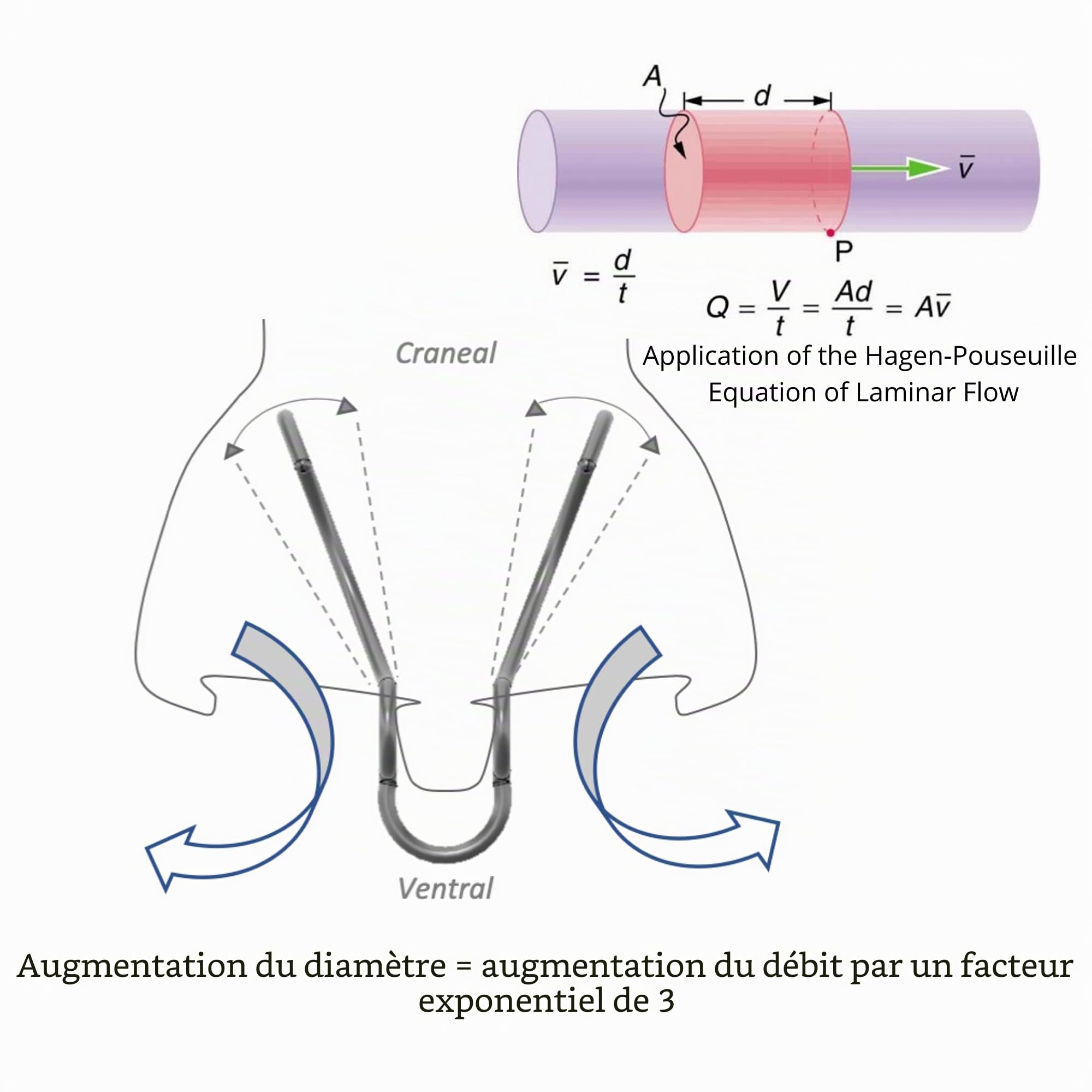Dilatateur nasal réglable réutilisable (petit) ouvre le nez pour respirer facilement