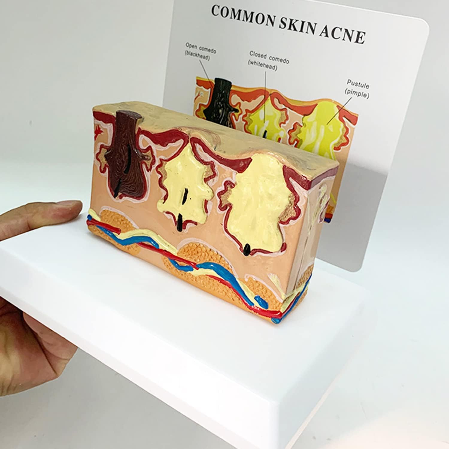 Human Skin Structure Model, Common Skin Acne Enlarge Structure Anatomical Model Tissue Hierarchical Hair Layer Medical Teaching Tool