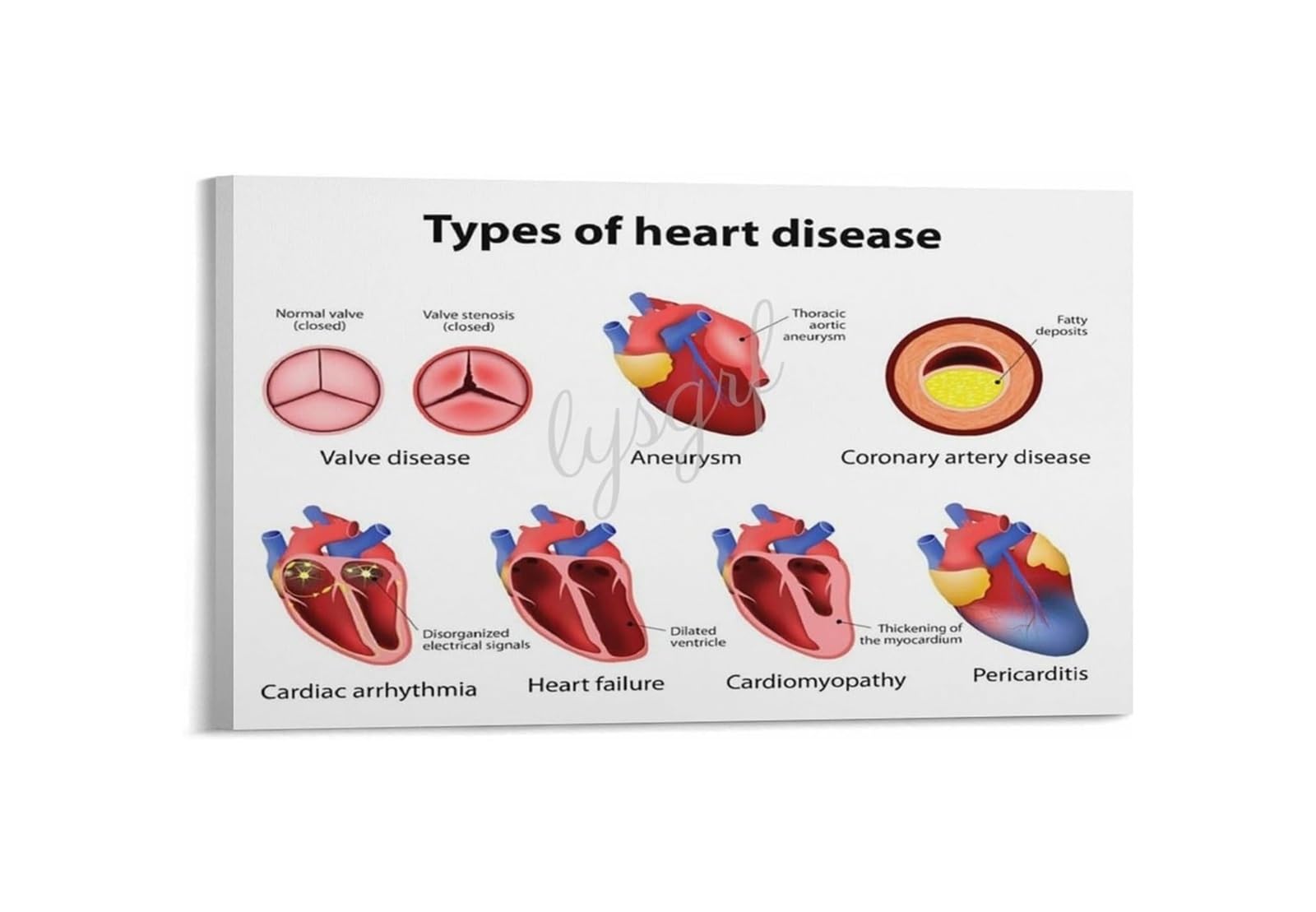 Affiche maladies cardiaques encadrée pour rassurer et informer en clinique