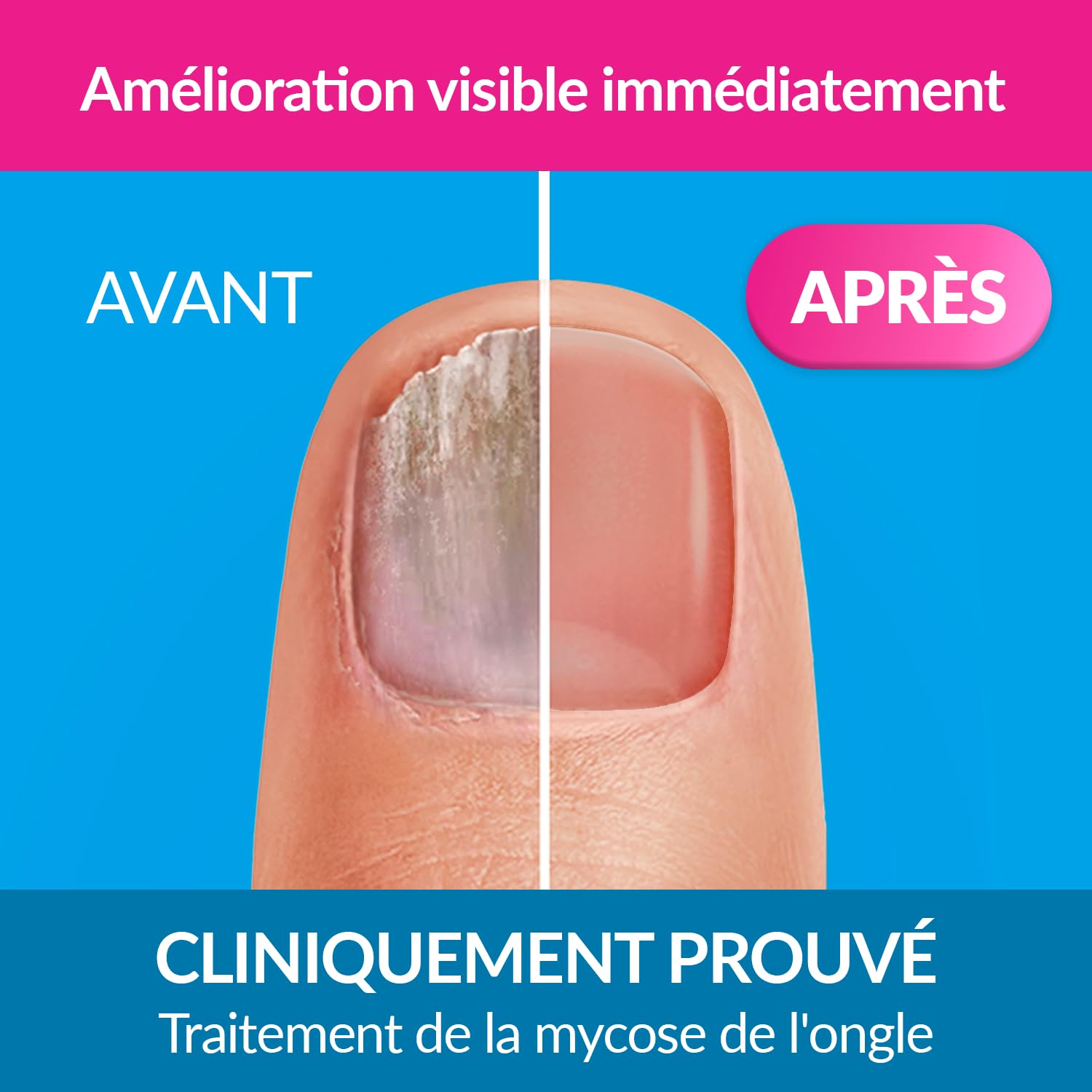 EXCILOR - Forte Color - Trattamento della micosi dell'unghia - Tratta e copre - Trattamento 30 ml + Smalto cosmetico per unghie da 8 ml - Clinicamente provato* - Nude