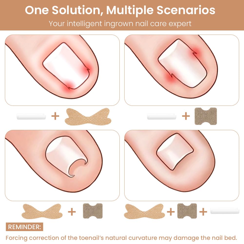Set di unghie Incarneato, 110 Pz Cerotti per Unghie + 50 Pz Strisce Raddrizzanti Per Unghie Incarnite Senza Dolore Con 1 Sollevatore Per Unghie