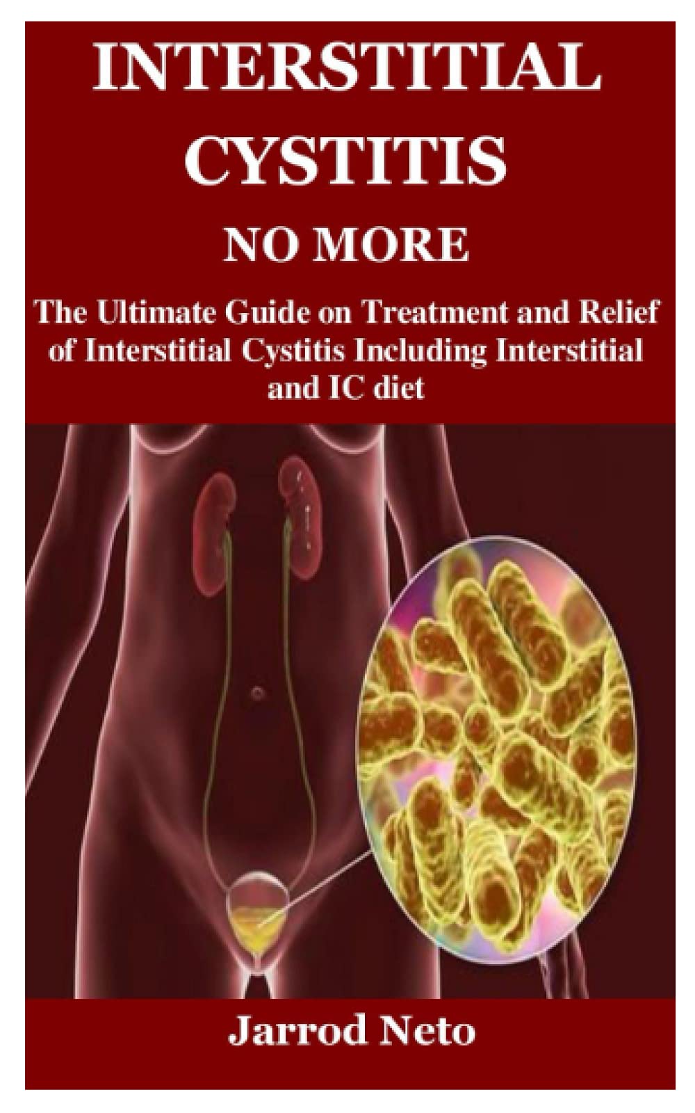 Buy INTERSTITIAL CYSTITIS NO MORE The Ultimate Guide on and of
