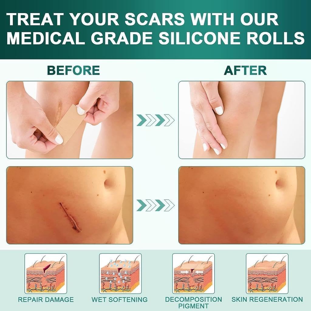 Scar Removal Tape Scar Removal Sheet Strips for C-Section, Acne Scars, Tummy Tuck, Keloid and Surgical Scars, Reusable Medical Grade Silicone Scar Tape, Get Scars Away Painless Reusable