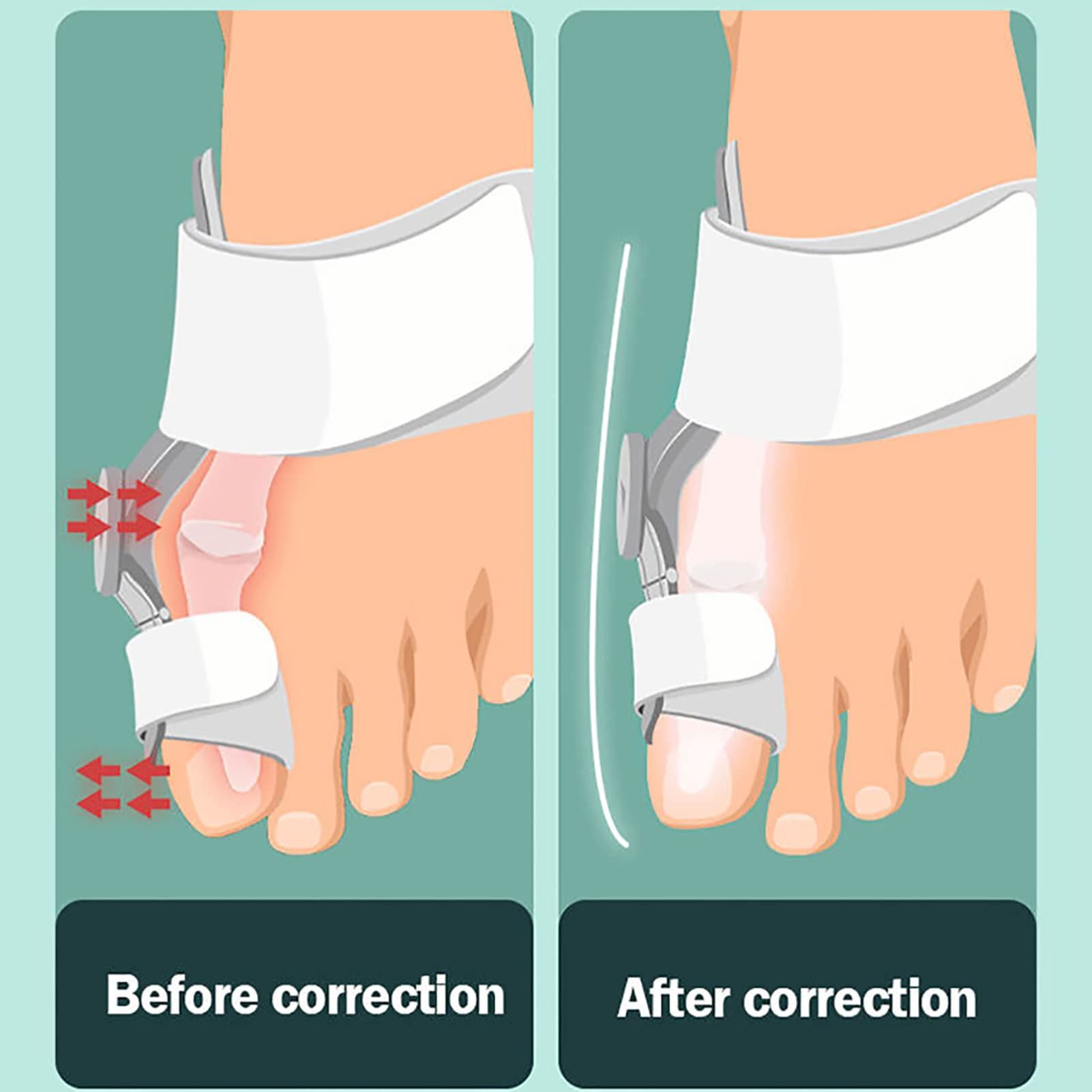 Ballenkorrektur-Glätteisen für große Zehen, Orthopädische Ballenschienen zur Linderung von Ballen, Verstellbare Ballenschiene mit Silikon-Innenpolster