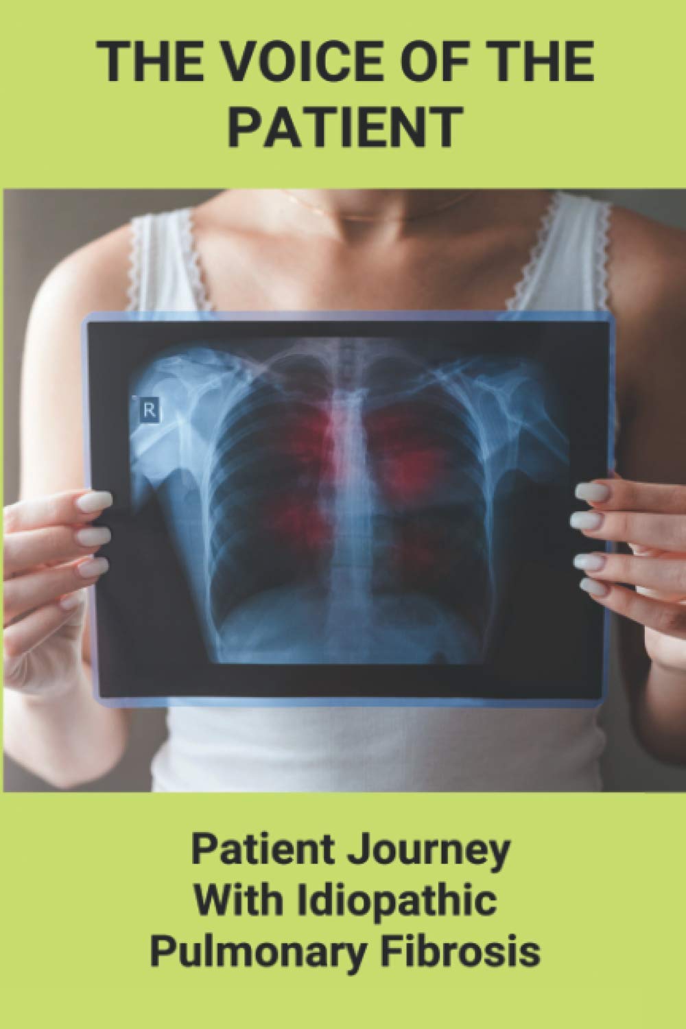 The Voice Of The Patient: Patient Journey With Idiopathic Pulmonary Fibrosis: New Mountains To Climb