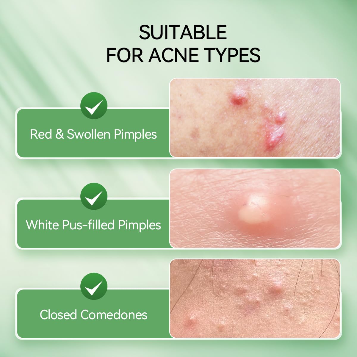 LANBENA Overnight Acne Drying Lotion Spot Treatment