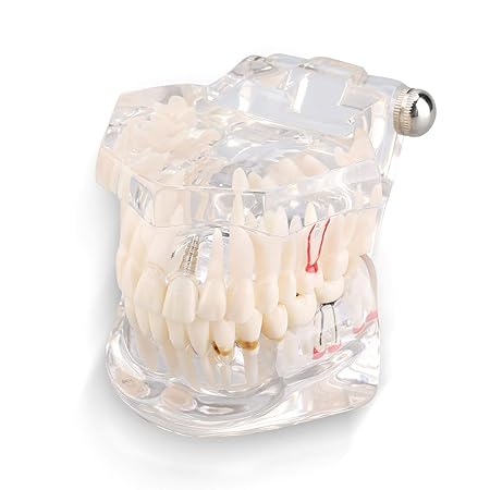 Detachable Tooth Model,Dental Disease Teaching Study Adult Typodont Demonstration Teeth Model New