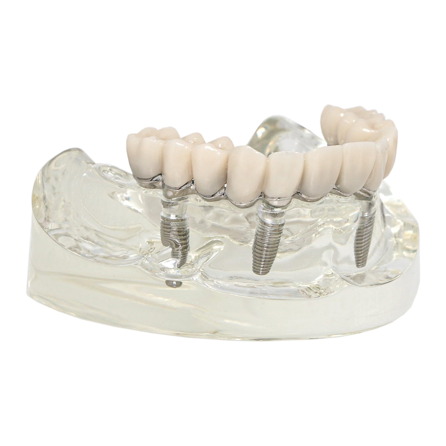 Dental Implant Model Upper All-on-4 Metal Framework Treatment Model with Detachable Overdenture Implants and 4 Screw Post Core Bridges M6023