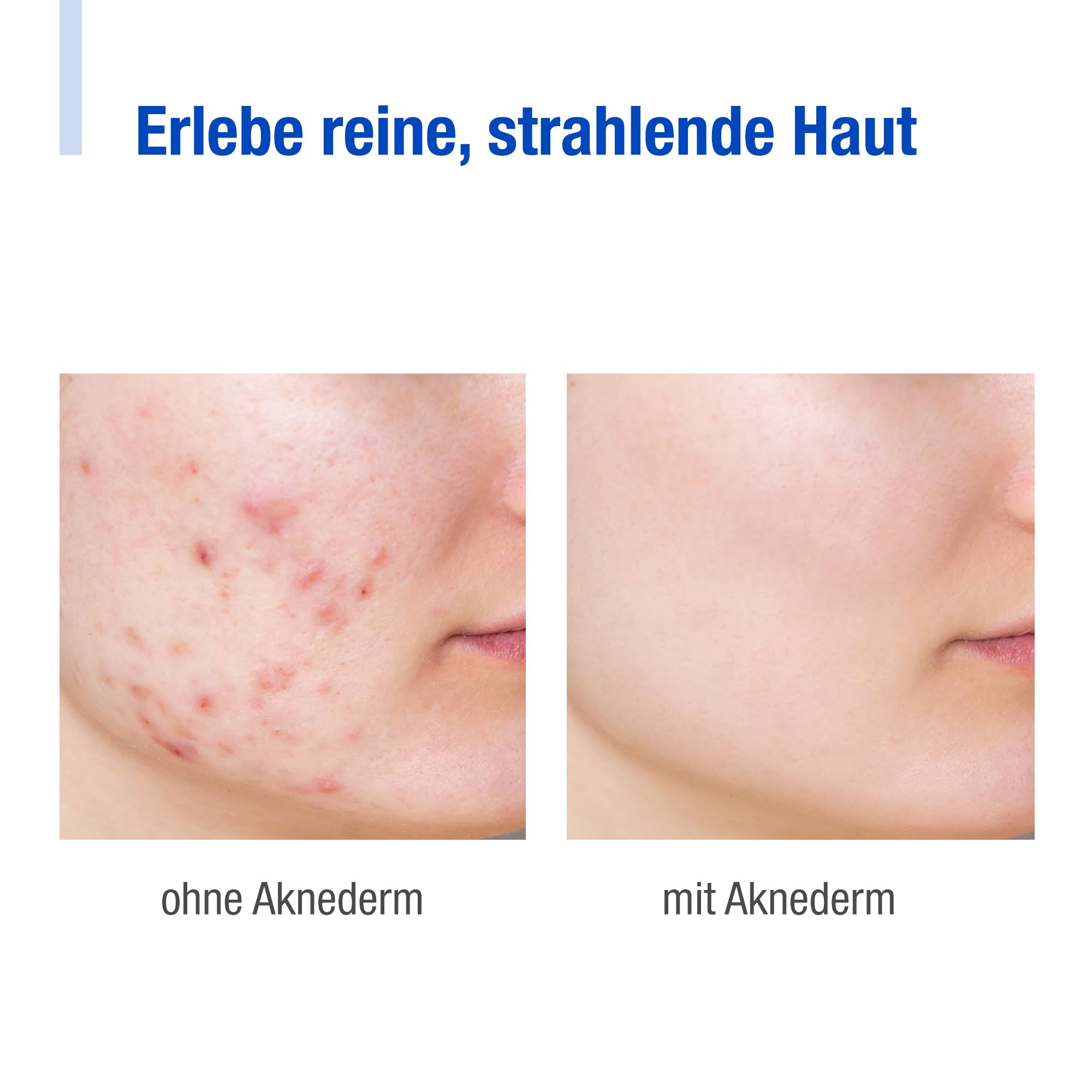 aknederm Premium Set intens für sensible Haut - Set mit Tinktur sensitiv/Reinigungsschaum/Lotion F/Creme intens & Reinigungspads - natürliches Skincare Set - ideal zur Akne Behandlung 230ml