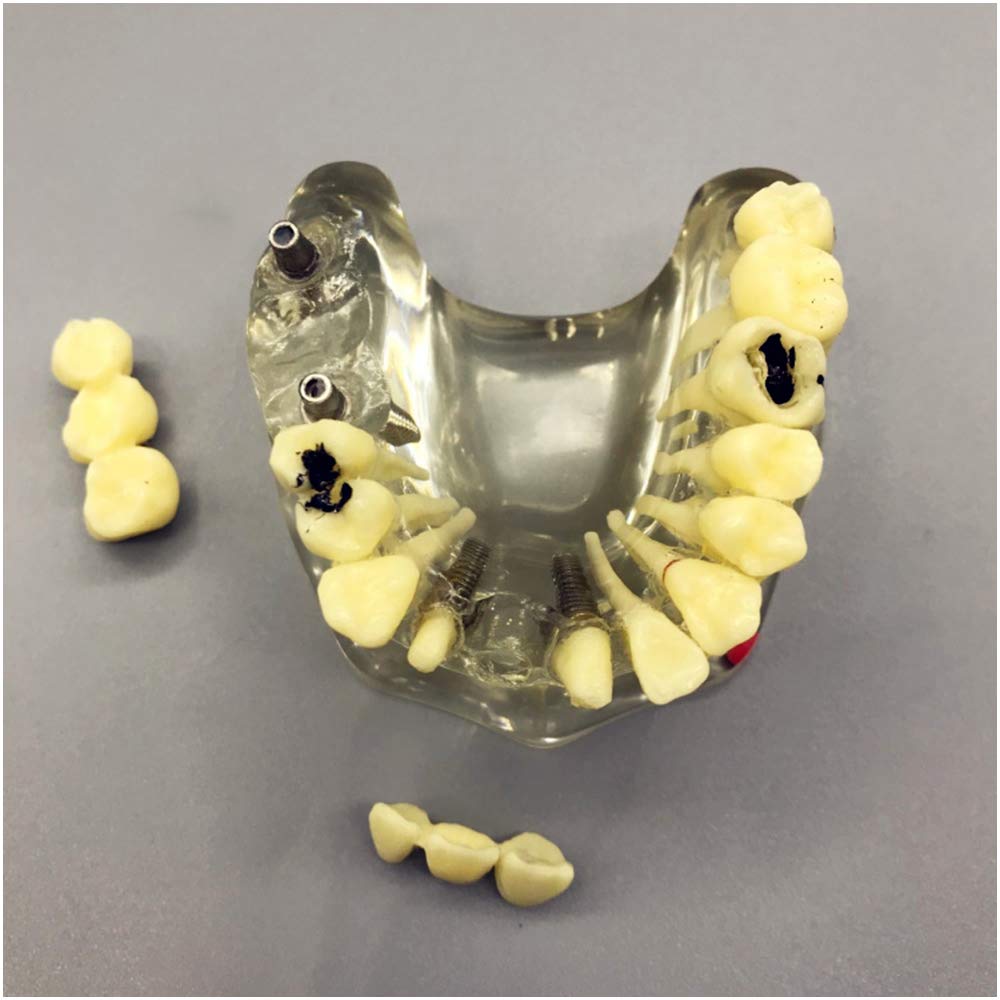 Sjdopulse A Teeth Implant Model - Implant Restoration Model With Removable Gum Nd Denture - Section Half-Port Bridge Restoration Planting Model For Study Teaching (A)