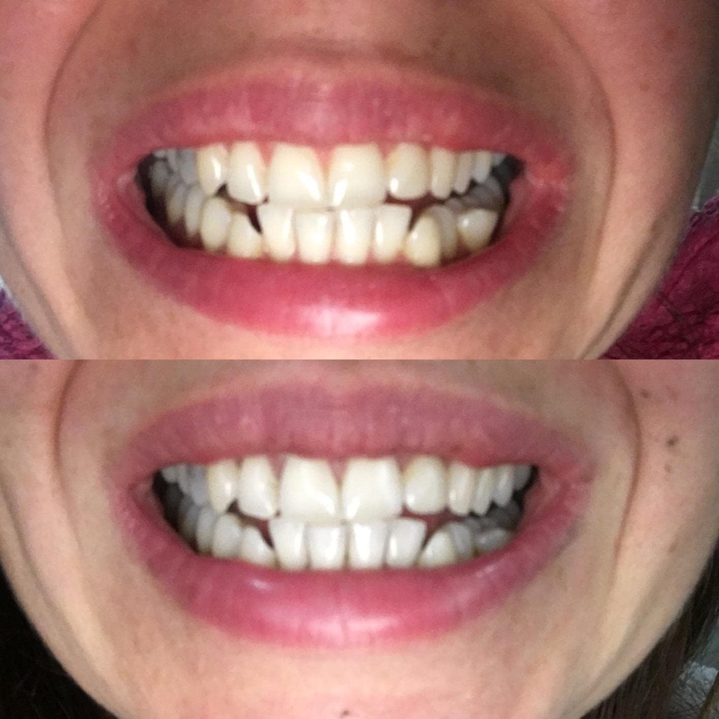 Activated Charcoal for Teeth Whitening, Natural Teeth Whitening Using Coconut Shells, RAW & Food Grade with No Artificial Flavours, 100% Natural, Large Tub, 80g=300 Uses from LiveCoco