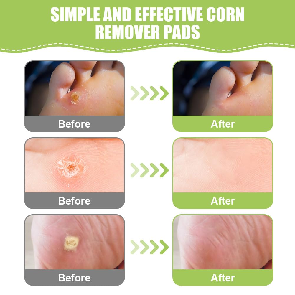 ACWOO Corn Remover, 48PCS Removedor de Maíz