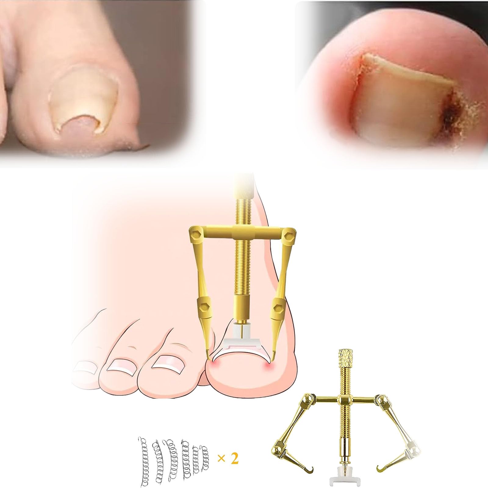 NALACAL Ingrown Toenail Treatment Kit, Ingrown Toenail Corrector Stainless Steel Pedicure Tools for Curve Correct Ingrown Toenail Treatment, Tools Kit for Ingrown Toenail, gold