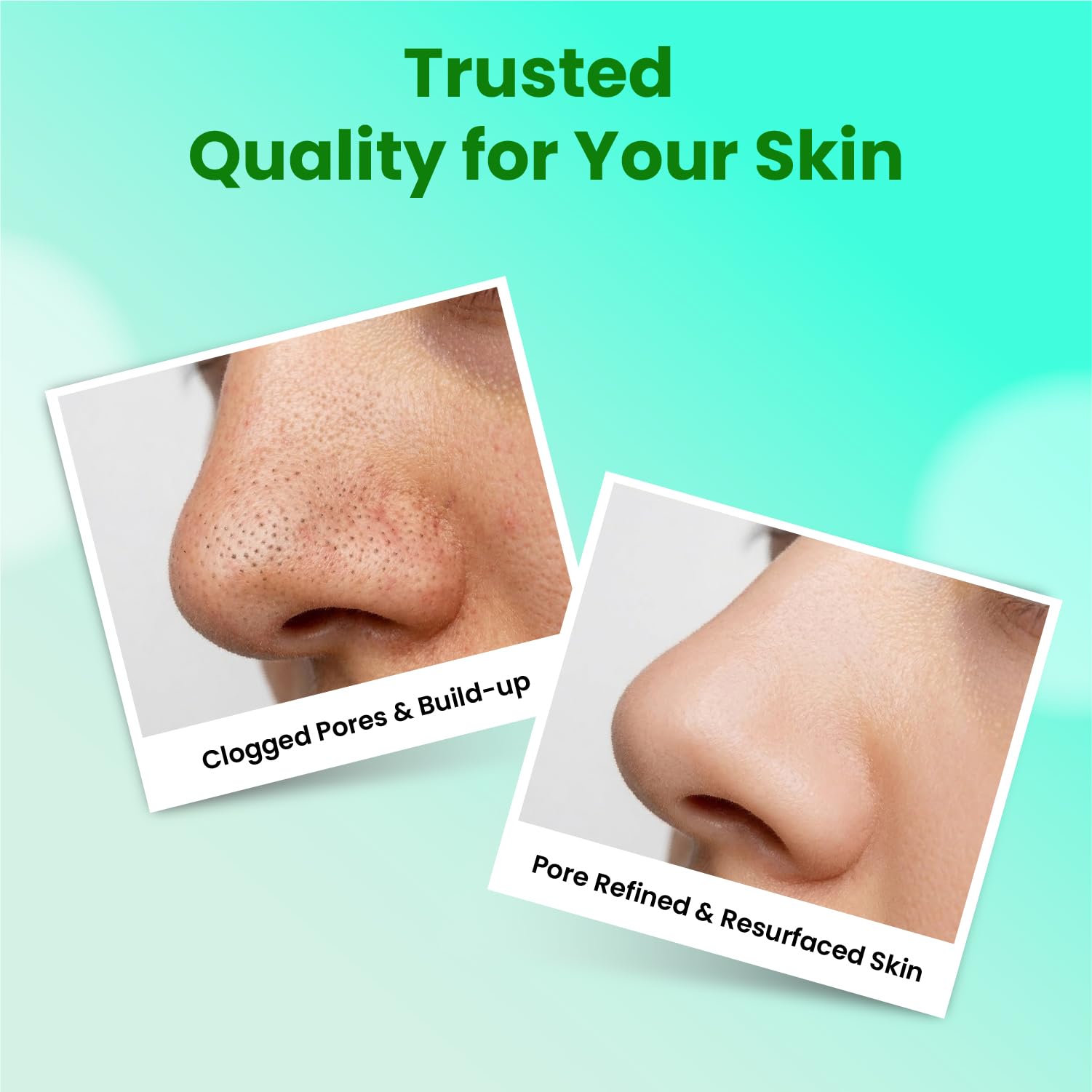 Kelmi Activated Charcoal Nose Strips for Blackhead Removal (10 Strips) | Deep Pore Cleansing Nose Strip | Removes Blackheads, Whiteheads & Excess Oil | Peel-Off Nose Pore Strips | Suitable for All Skin Types