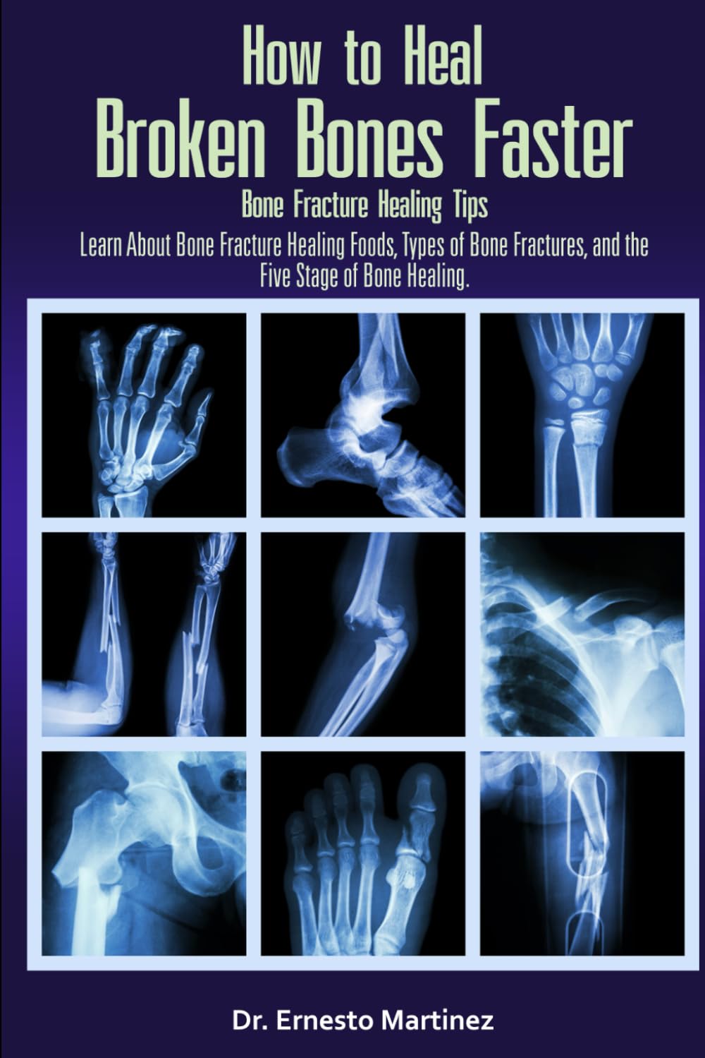 How to Heal Broken Bones Faster. Bone Fracture Healing Tips: Learn About Bone Fracture Healing Foods, Types of Bone Fractures, and the Five Stages of Bone Healing (Health and Wellness)