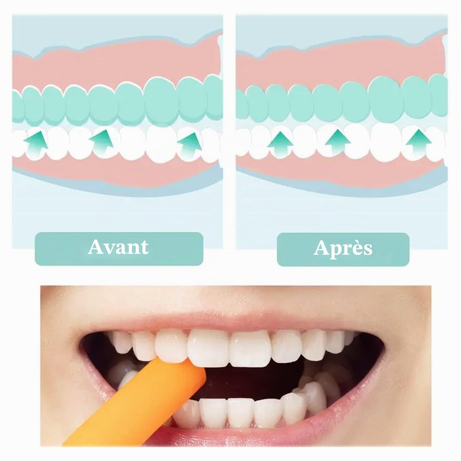 Lot de 12 aligneurs dentaires à mâcher pour gouttières orthodontiques, réutilisables (6 couleurs)