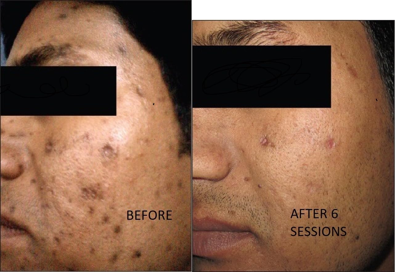 TCAPlatinumDerm 95% Peel (0.3oz/10ml) medium depth chemical peel ideal for Dilutions and spot application on scars with CROSS Technique, for Aestheticians and DIY skincare enthusiasts - Image 8