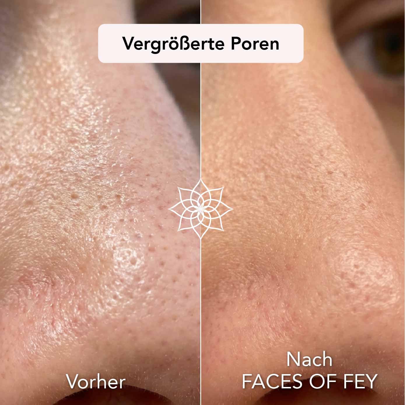 FACES OF FEY Derma roller 0,25 mm, 192 prawdziwe igły, 10% niacynamidu