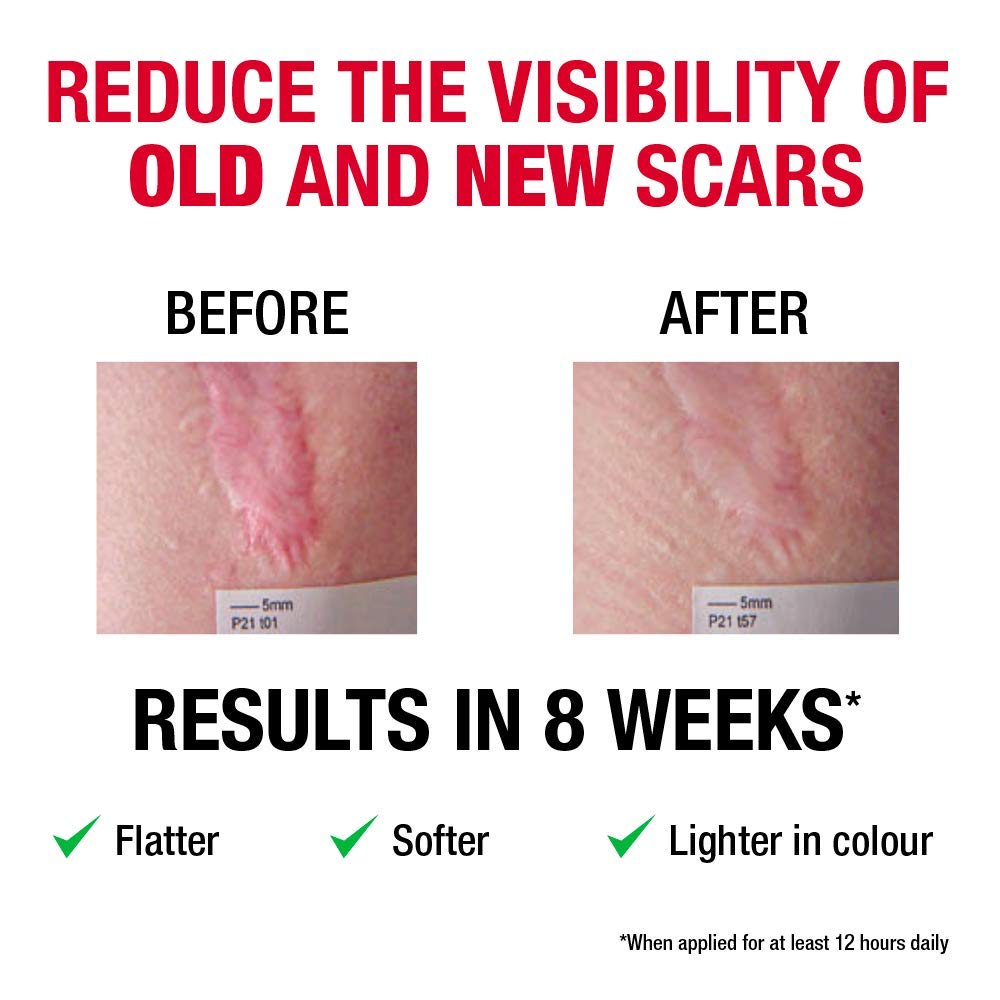 Elastoplast XL Scar Reducer Plasters (21 Pieces), Extra Large Scar