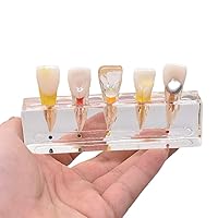 Vista 2 de Modelo patológico de restauración de pulpa dental de diente frontal, modelo endodóntico humano