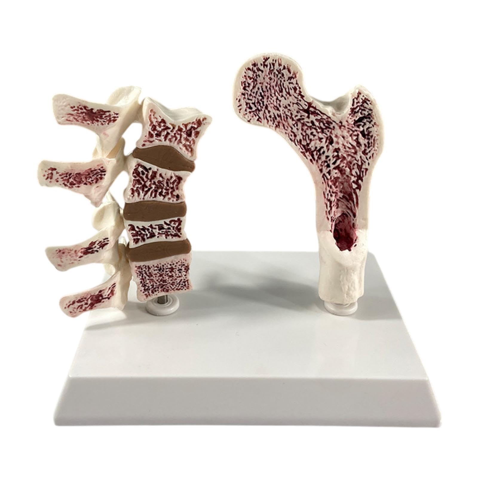Modelo Portátil de Fémur Humano con Osteoporosis, Esqueleto Educativo con Vértebras, Kit de Aprendizaje de Material de PVC, Adecuado para La