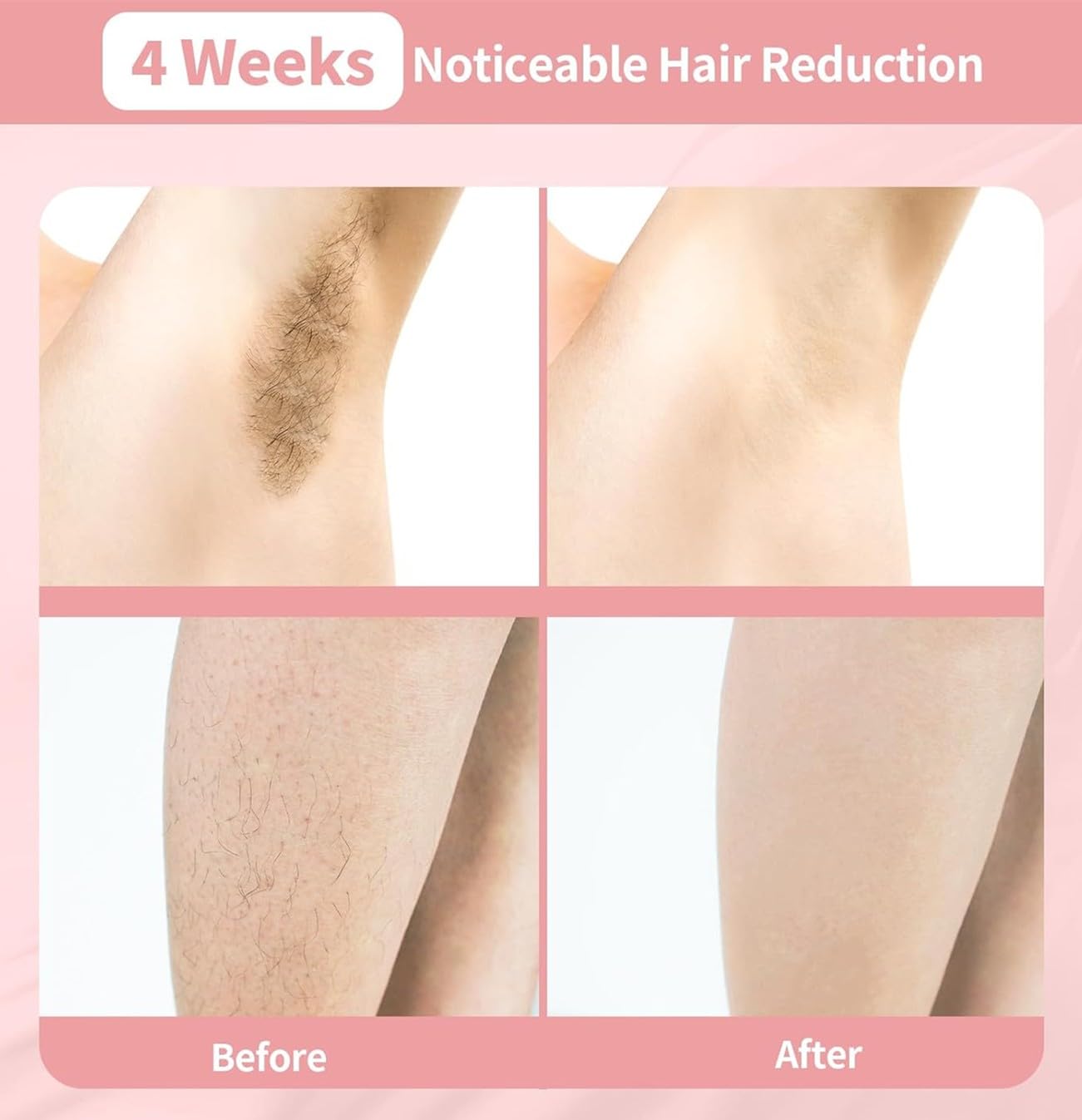 Dispositivo di epilazione laser a diodo, rimozione indolore e permanente dei peli su tutto il corpo, adatto a viso, braccia, gambe e zona bikini, unisex