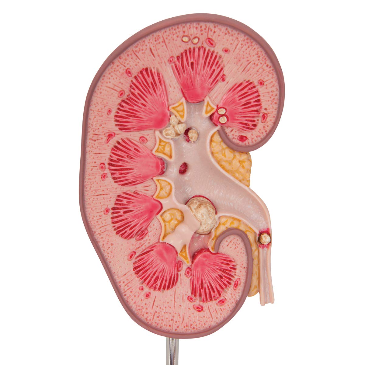 3B Scientific Anatomia ludzka - model z kamienia nerkowego + bezpłatne oprogramowanie anatomiczne - 3B Smart Anatomy, K29