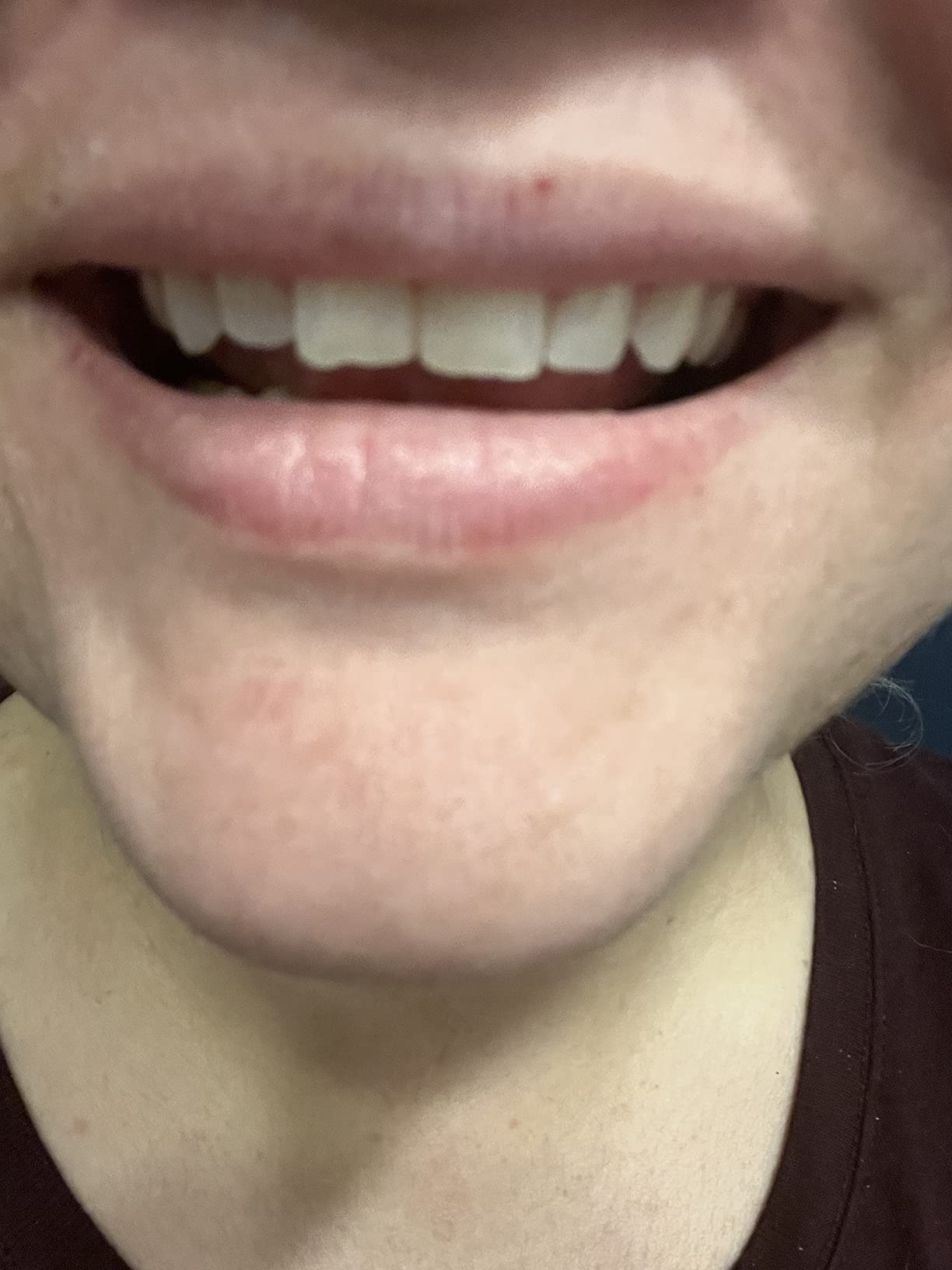 9/mo Finance mastermedi Zinc Oxide Eugenol Cement Dental Care Kit Glue For Crowns & Bridges