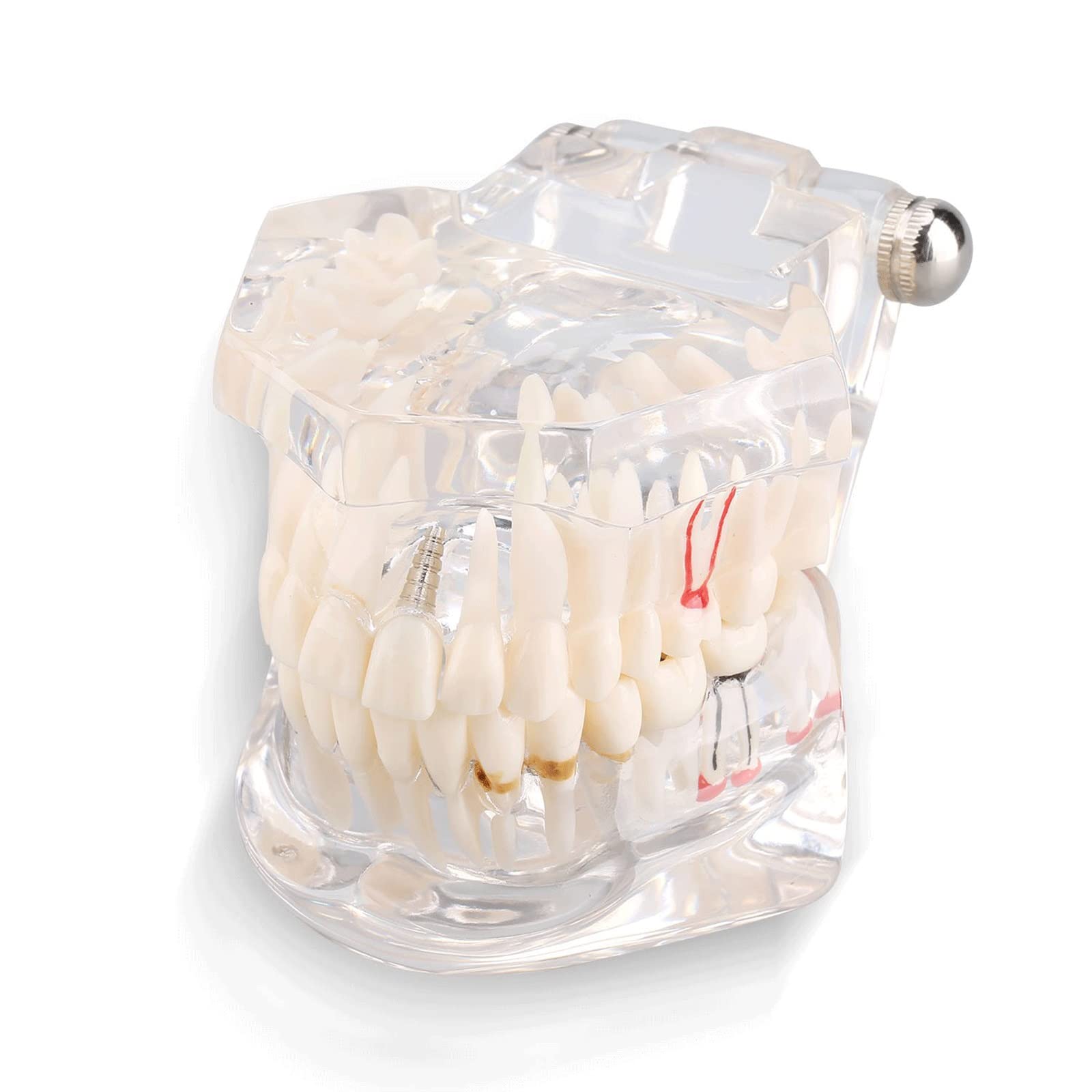 Modelo De Dientes, Implantación Dental Transparente Modelo De Diente De Enfermedad Modelo De Diente Activo Modelo De Diente Patológico Modelo De Reparación Oral Desmontable Estudio De Enseñanza Dental