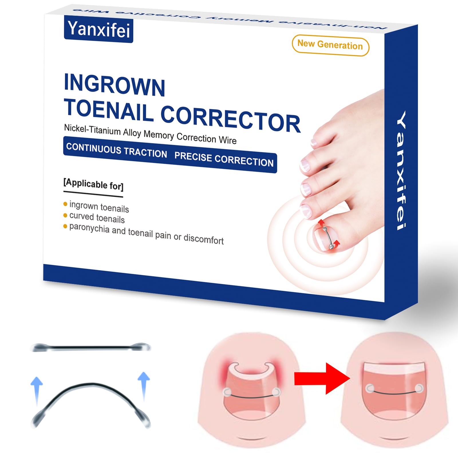 Nitinol Ingrown Toenail Corrector,at Home Ingrown Toenail Treatment,Curved Toenail Straightener,Ingrown Toe Nail Relief,Ingrown Toenail Removal Kit (1/2 In,11/16 In)