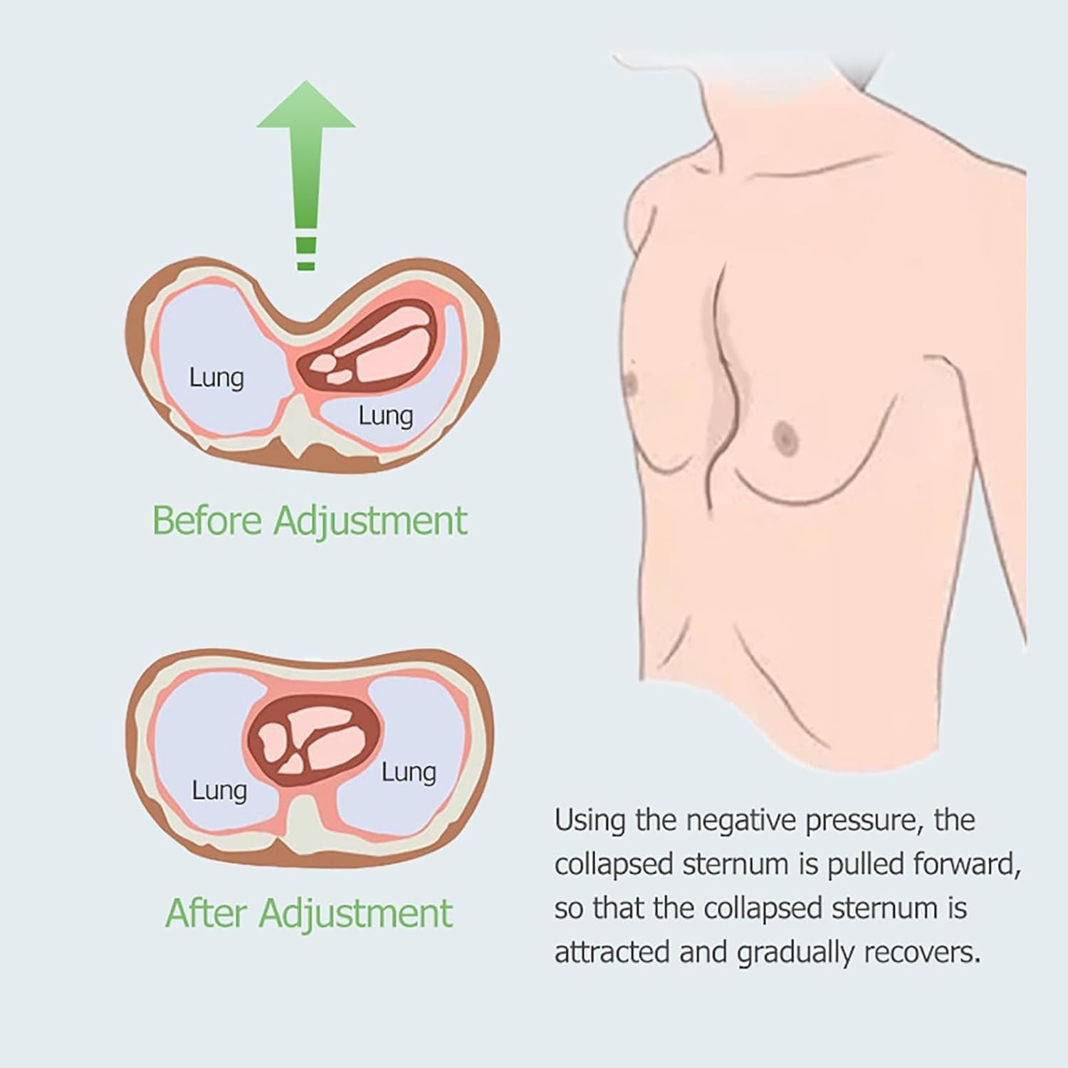 Soporte esternal para Pectus Excavatum, corrector de pecho de silicona médica, ajustable, para adultos y niños