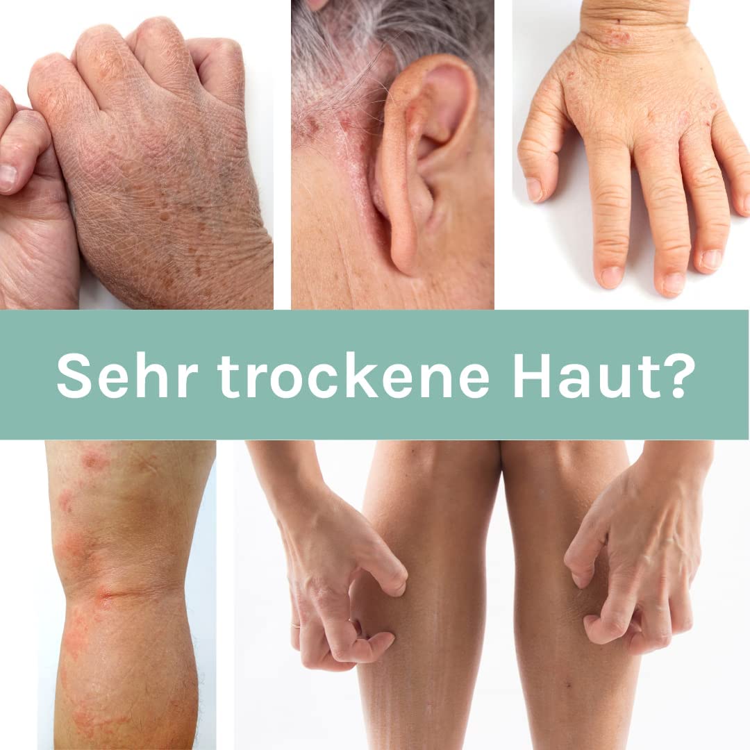 benevi ISO-Intensivcreme 75 ml mit Magnesium und Urea für trockene juckende schuppende Haut - auch als Basispflege bei Altershaut und zu Neurodermitis oder Schuppenflechte neigender Haut