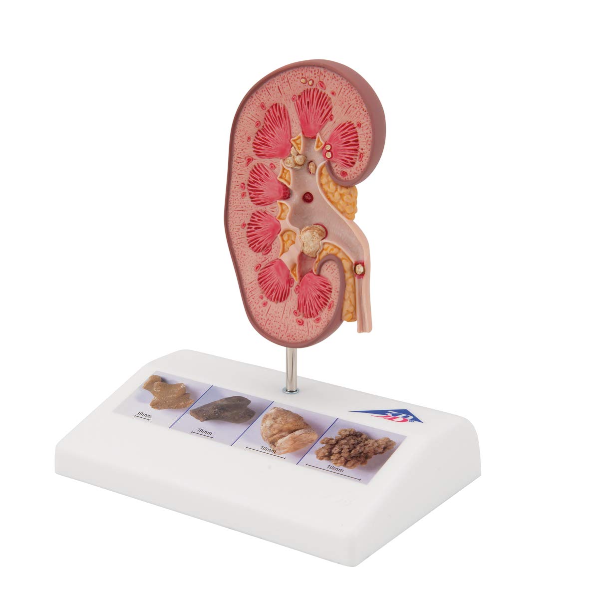 3B Scientific Anatomia ludzka - model z kamienia nerkowego + bezpłatne oprogramowanie anatomiczne - 3B Smart Anatomy, K29