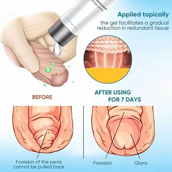Redundant Prepuce Correction Gel,Phimosis Cream for Adults,Natural Gentle,Male Foreskin Phimosis Correction Care Gel Phimosis Cream for Adults. (1Piece)