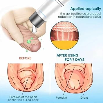 Redundant Prepuce Correction Gel,Phimosis Cream for Adults,Natural Gentle,Male Foreskin Phimosis Correction Care Gel Phimosis Cream for Adults. (1Piece)
