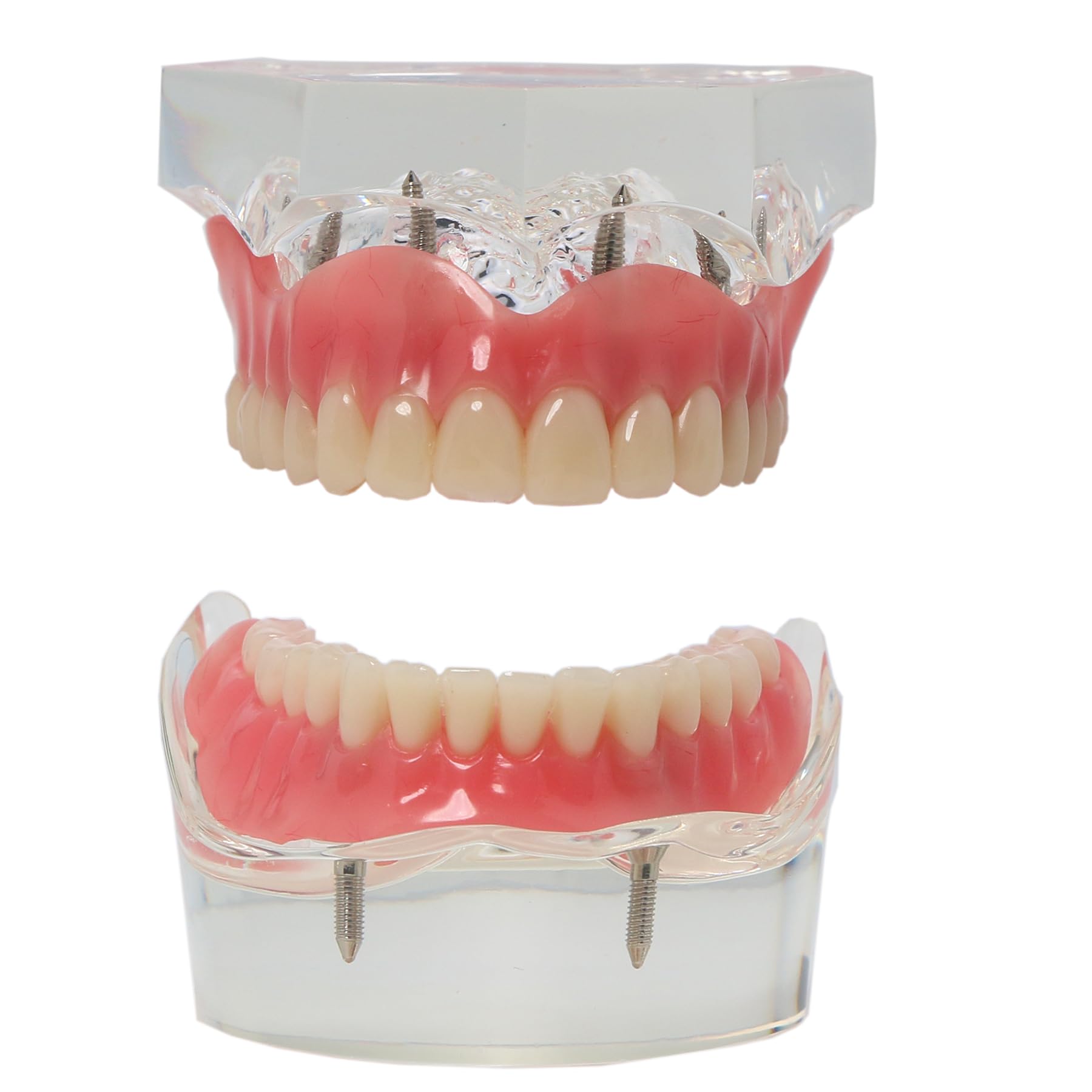 Dental Implant Model, All on 4 Overdenture Model, Upper/Lower Jaw Kit, Removable, Upper with 4 Implants,Lower with 2 Implants (M6001+M6002-1 Kit)