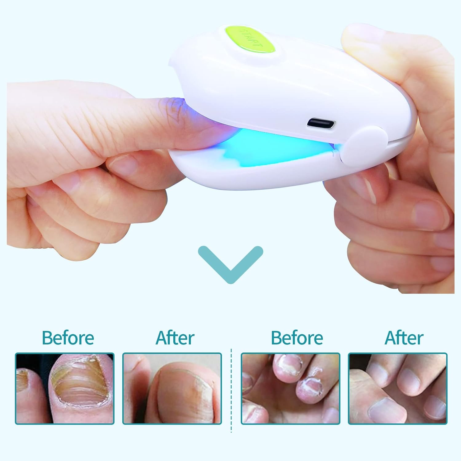 Nail Fungus Cleaning LaserDevice for Onychomycosis, Revolutionary Home Use Nail-fungus Remover, Upgraded Highly Effective Rechargeable Nail Fungus Treatment Device, Improving the Health of Unsightly Nails for Fingernails and Toenails (Upgrade Version Two Pieces) : Health & Household