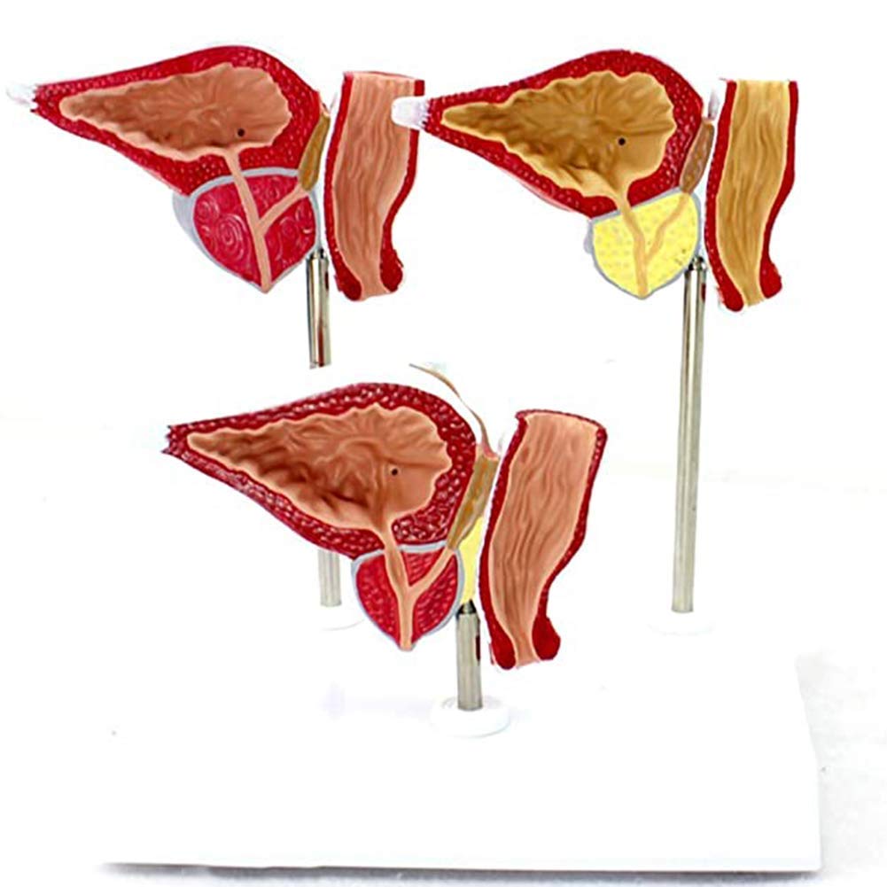 Human Anatomical Prostate Model -1: 1 Life-Size Prostate Model PVC Material Normal and Injured Representation Human Anatomy Science Models