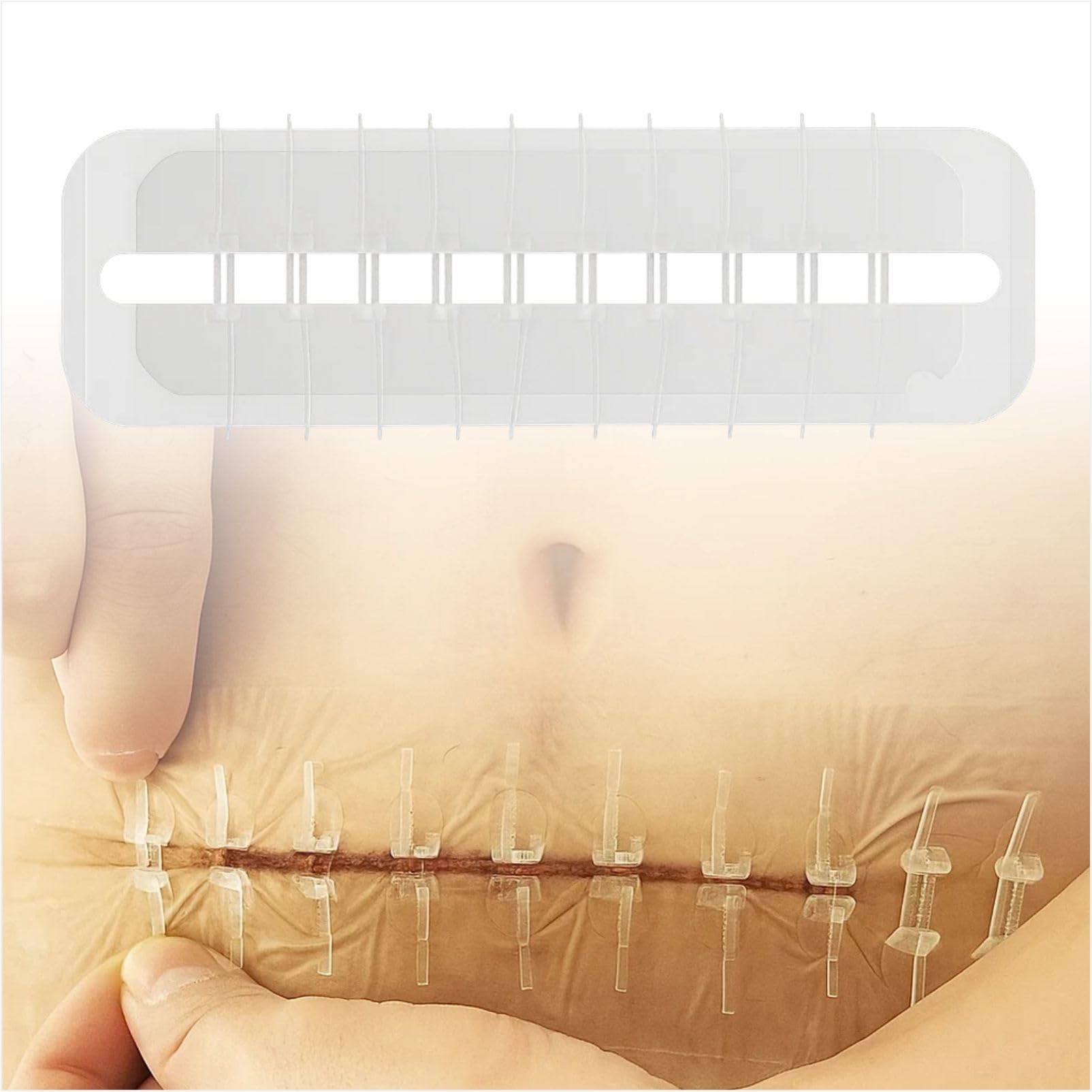 Mediss Emergency Wound Closures Band-Aid Adhesive Bandages, Zip Stitch Stickers Device After Caesarean Birth, Injury, Survival (1 Pcs x Individually Wrapped)