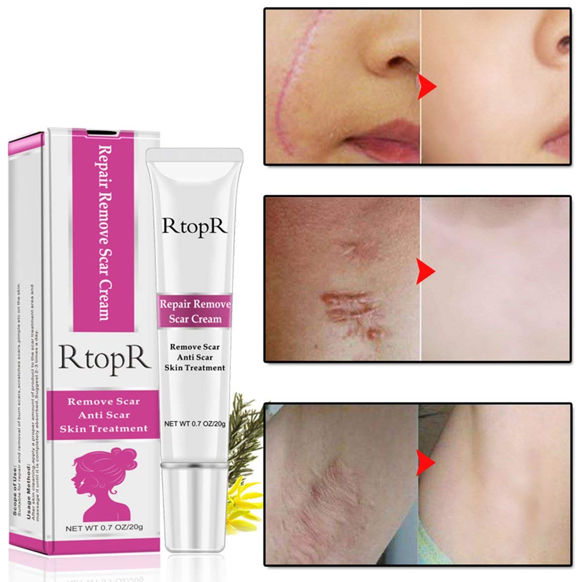 Buy RtopR Acne Scar Removal Cream Fast Skin Tag Remover Remove Scar
