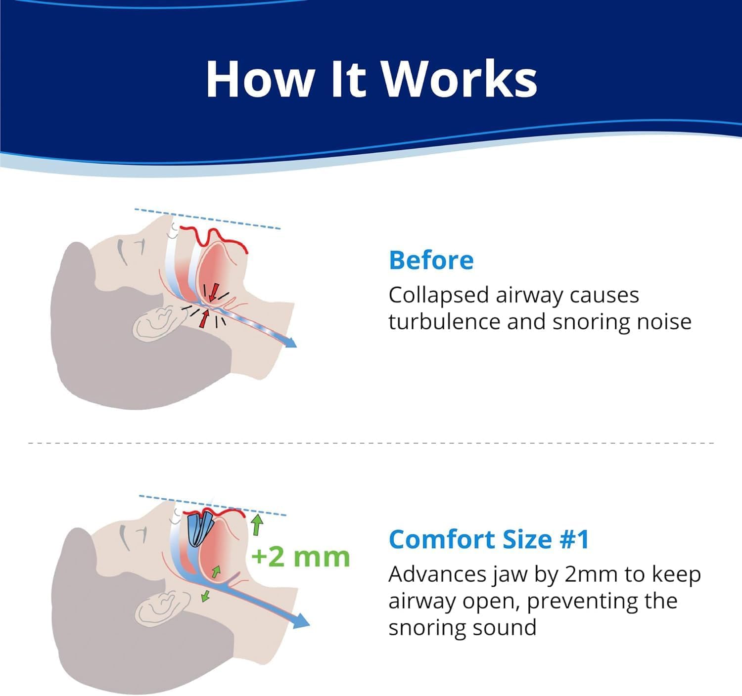 Honex The Quiet Anti-Snoring Mouthpiece Universal Size,Anti-Schnarch-Zahnschiene Für Einen Ruhigen Schlaf (2pcs)
