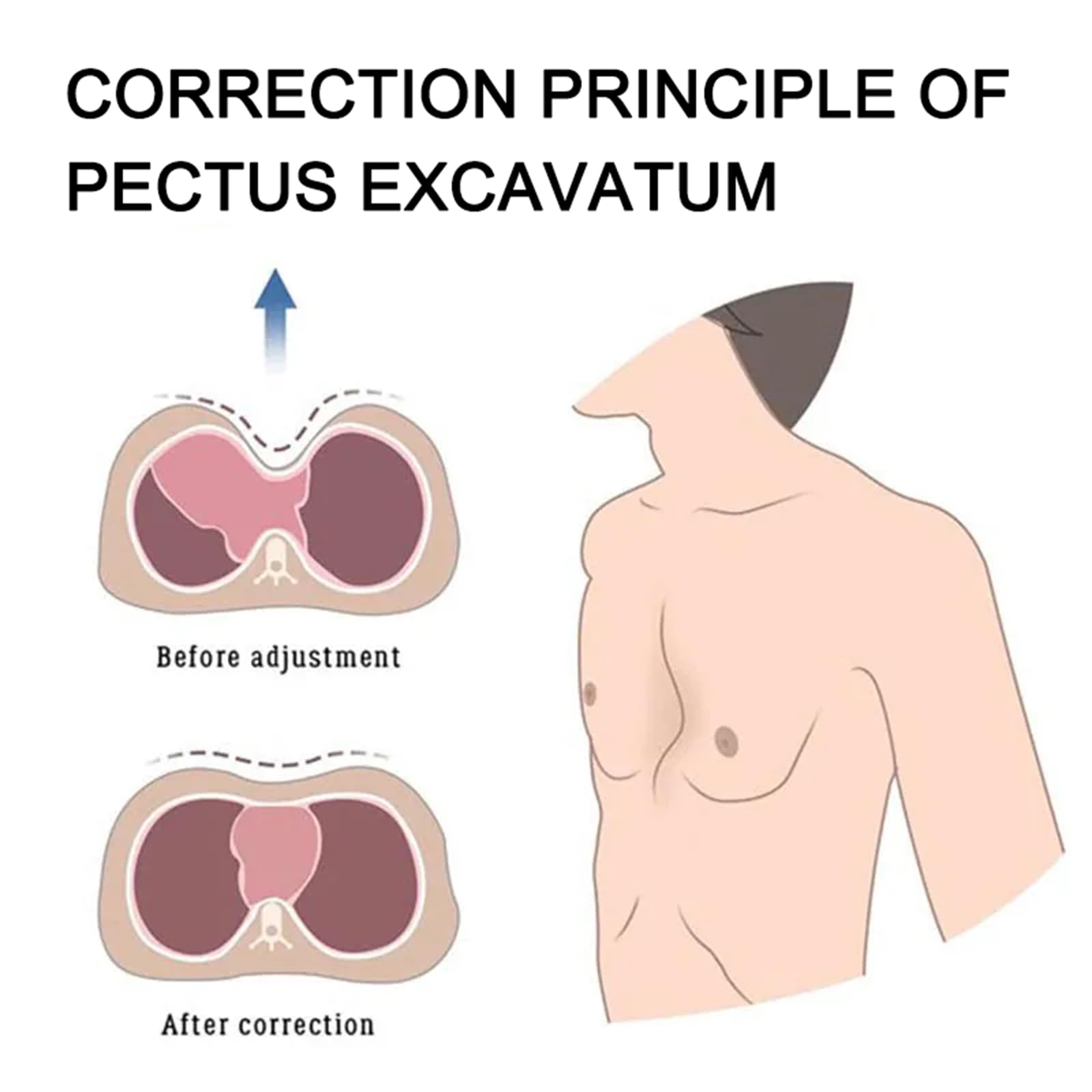HMWOKPOT Pectus Excavatum Funnel Chest Brace, Thoracic Depression Brace Correction Principle of Pectus Excavatum for Kids Men Women,25cm