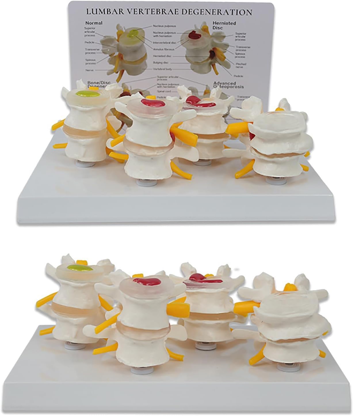 Agvhqc 4-Stage Human Lumbar Spine Model With Herniated Disc, Bone & Disc Degeneration, Advanced Osteoporosis, Clear Color-Coded Structure & English Back Card For Medical Education & Anatomy Learning