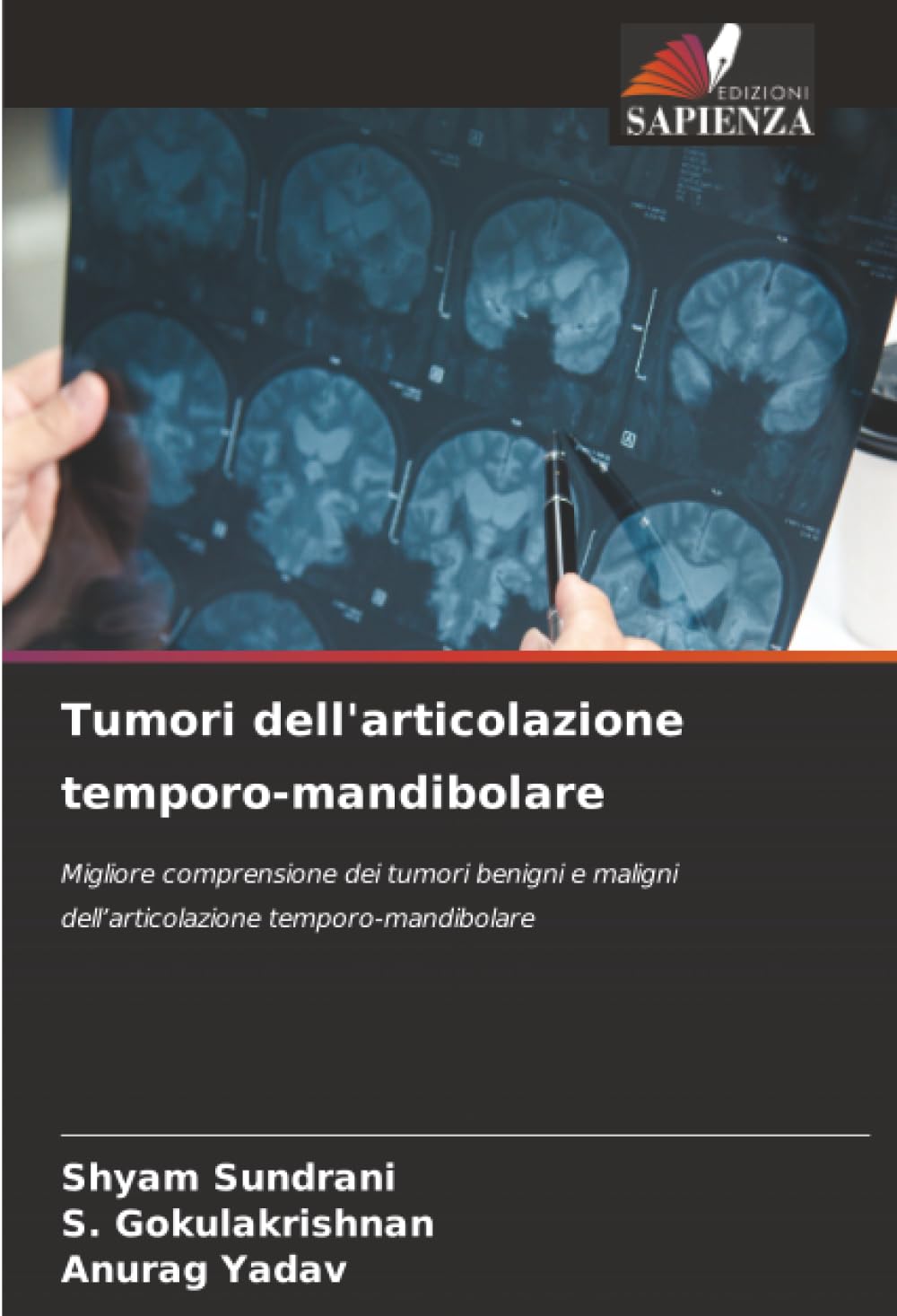 Tumori dell'articolazione temporo-mandibolare: Migliore comprensione dei tumori benigni e maligni dell’articolazione temporo-mandibolare