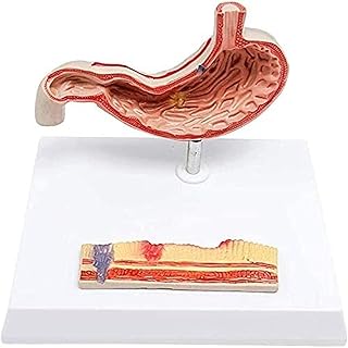 Organ Model Human Organ Gastric Ulcer Stomach Diseased Anatomy Model for Study Teaching Anatomical Model
