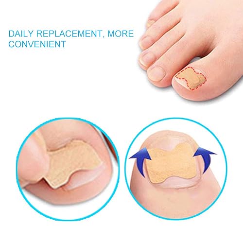 Miniatura 5 de Parche de corrección de uñas suaves e indoloras, corrector de uñas encarnadas de pedicura, profesional para hombres y mujeres, herramienta de