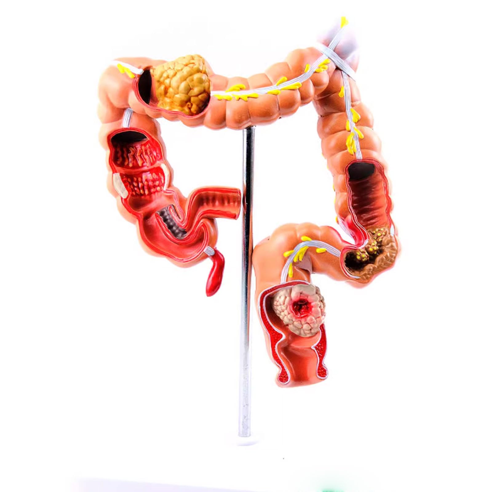 The Large Inestine Model Large Intestine Model With Diseases Anatomystuffcouk Intestinal